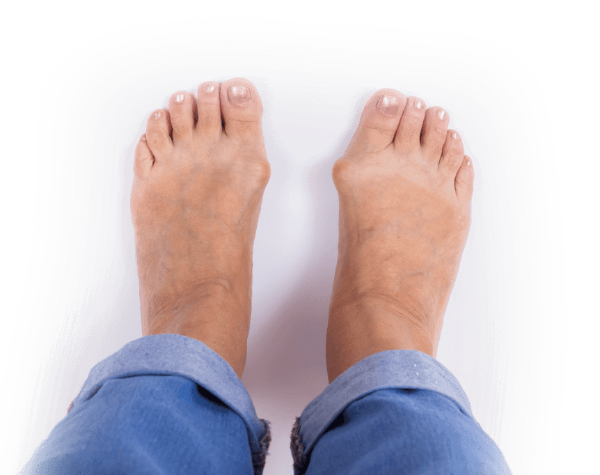 Bunion deformity and forefoot alignment
